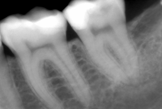 Hamamatsu intra orale sensor-size 2-364